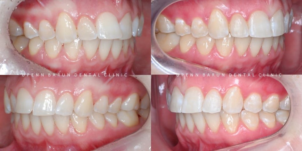 잠실교정치과 유펜바른치과의 인비절라인익스프레스가 특별한 이유 (5개월 인비절라인급속교정 잠실인비절라인 송파인비절라인 인비절라앞니부분교정) 관련 이미지 16