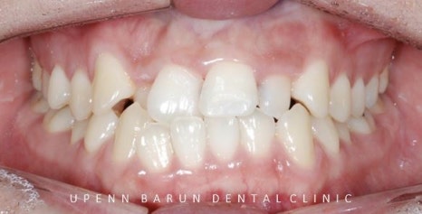 잠실데이몬교정, 비발치교정, 잠실덧니교정 (AKA Damon Smile) 관련 이미지 7