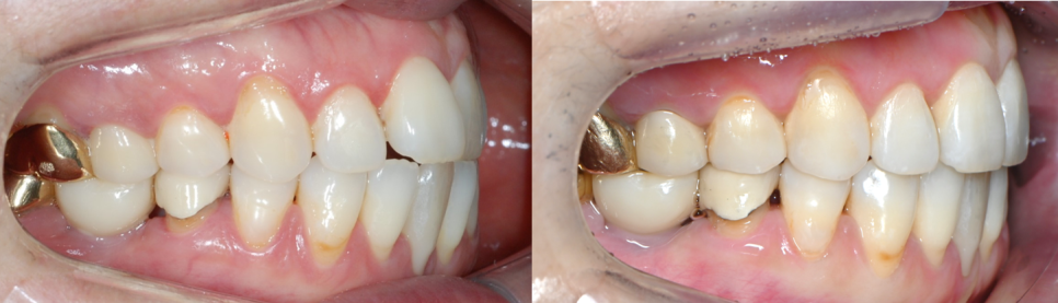 인비절라인 공식 스피커가 상주하고 치료하는 송파교정잘하는치과 유펜바른치과 (잠실성인교정 잠실재교정 잠실인비절라인 성인인비절라인교정 잠실나루역교정치과 문정동교정치과 삼전역교정치과) 관련 이미지 17