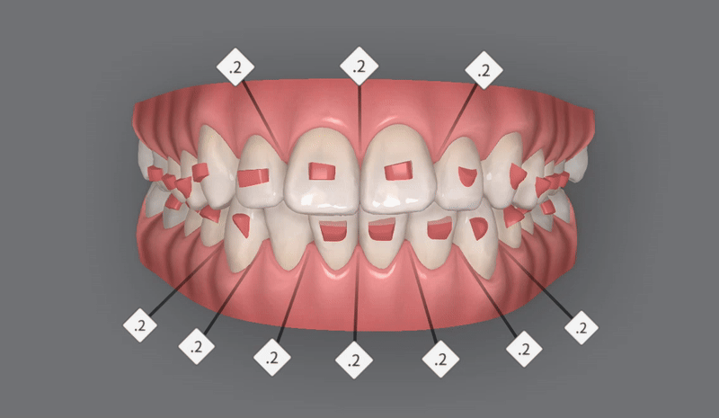 가지런했던 앞니가 삐뚤빼뚤해졌어요! 잠실다이아몬드등급 잠실인비절라인 인비절라인익스프레스 앞니 삐뚤어짐 해결(앞니급속교정 앞니투명교정 인비절라인급속교정 인비절라인전후사진) 관련 이미지 6