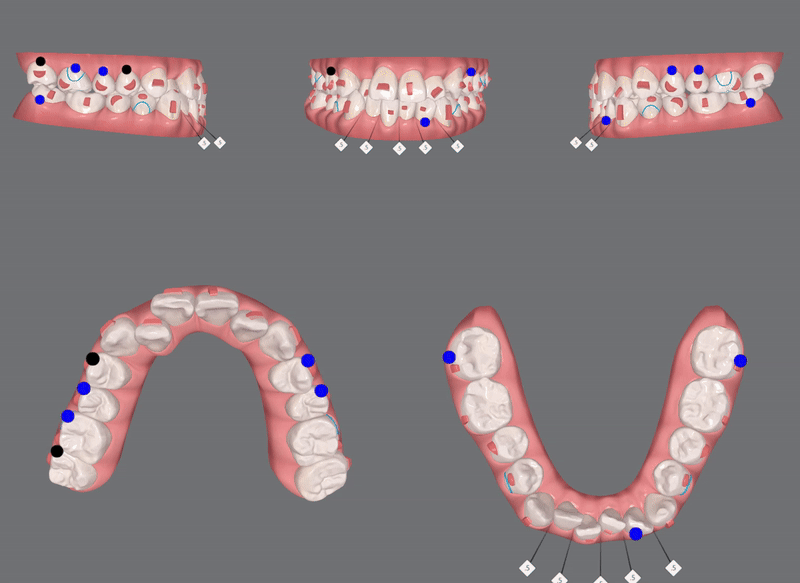 송파인비절라인다이아몬드등급 치과에서 악궁확장장치 없이 반대교합 해결한 후기(인비절라인높은등급 인비절라인반대교합 인비절라인비발치교정 인비절라인잘하는치과 인비절라인교정전문) 관련 이미지 8