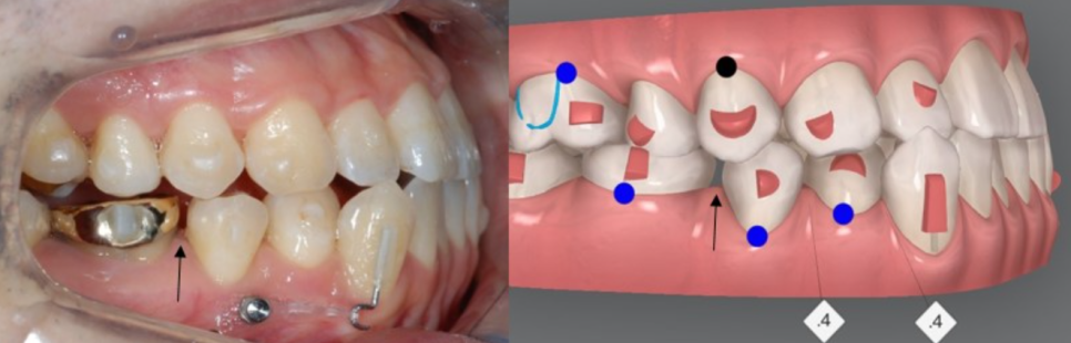 주걱턱 반대교합도 잠실인비절라인 잠실교정치과 유펜바른치과에서!(비발치주걱턱교정 잠실성인교정 반대교합인비절라인 잠실교정치과 주걱턱교정후기) 관련 이미지 12