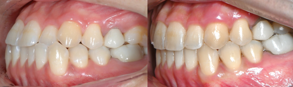 주걱턱 반대교합도 잠실인비절라인 잠실교정치과 유펜바른치과에서!(비발치주걱턱교정 잠실성인교정 반대교합인비절라인 잠실교정치과 주걱턱교정후기) 관련 이미지 9