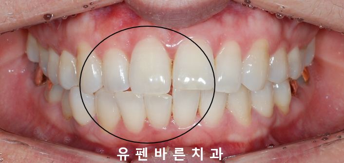 인비절라인으로 재교정, 가능할까용?? 관련 이미지 2