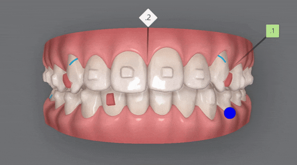 잠실소아인비절라인 잠실어린이인비절라인 송파인비절라인 잠실인비절라인후기 (잠실새내교정치과 엘스상가교정치과 파인애플상가교정치과 잠실새내역인비절라인 청소년교정후기 잠실인비절라인퍼스트) 관련 이미지 13