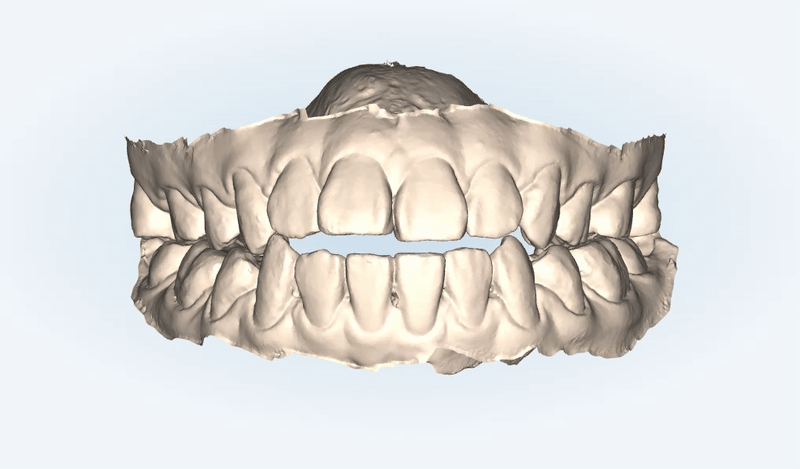 반대교합+개방교합 비수술교정 유펜바른치과에서 재교정한 후기! ( 비발치개방교합 비발치반대교합 재교정후기 잠실교정치과 미니스크류비수술교정 악궁확장장치 MARPE) 관련 이미지 5