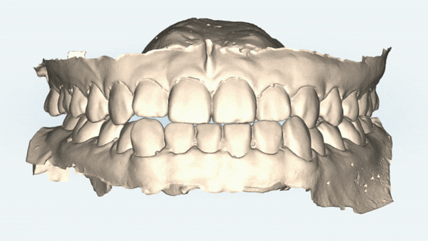 주걱턱교정, 수술교정, 양악수술도 잠실교정치과 유펜바른치과에서 관련 이미지 11