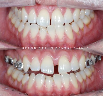 ABO 미국 치과교정과 전문의의 비수술치아교정 악궁확장장치 후기 (잠실교정전후 잠실새내교정치과 잠실교정치과 교정통증  앞니 변화) 관련 이미지 10