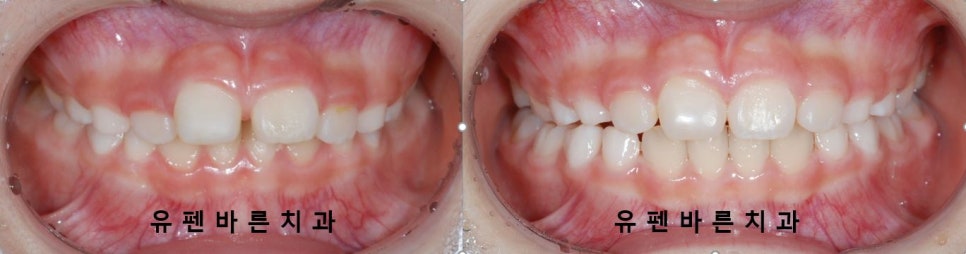 저도 친구들이 많이 하는 인비절라인교정 하고싶어요! 관련 이미지 7