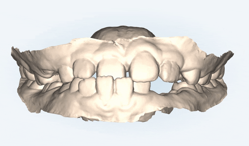 다이아몬드등급치과에서 인비절라인퍼스트로 반대교합 해결! 1차, 2차교정을 한번에!( 어린이반대교합 송파인비절라인퍼스트 잠실엘스상가교정치과 잠실인비절라인퍼스트 인비절라인스피커치과) 관련 이미지 4