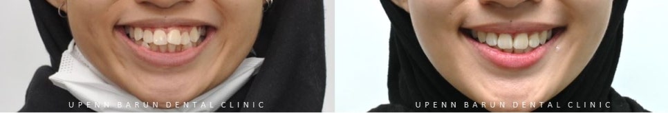 잠실돌출입교정 잠실발치교정 후기가 궁금하다면? (교정후얼굴변화후기 잠실교정치과 돌출입교정후기 돌출입전후사진) 관련 이미지 13