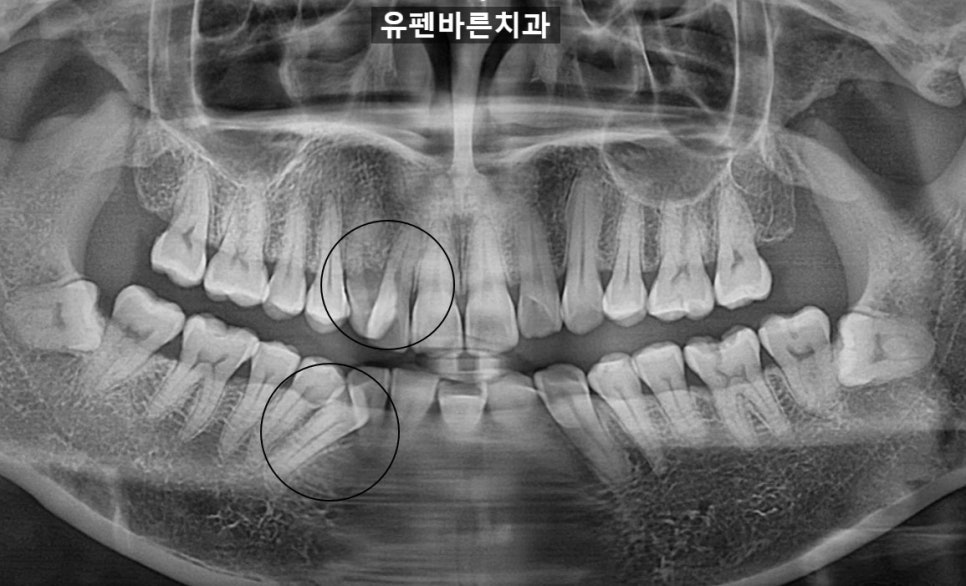 해외거주 중인데 발치교정도 인비절라인으로 가능한가요? 관련 이미지 2