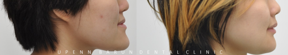 주걱턱교정, 수술교정, 양악수술도 잠실교정치과 유펜바른치과에서 관련 이미지 13
