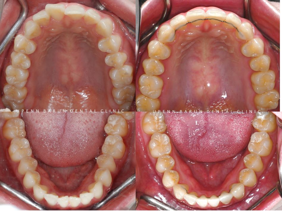 앞니부분교정 인비절라인라이트로 해결하기 (잠실인비절라인치과 송파인비절라인치과 잠실새내인비절라인치과 강동인비절라인치과 헬리오시티인비절라인 송파역인비절라인 석촌역인비절라인) 관련 이미지 16