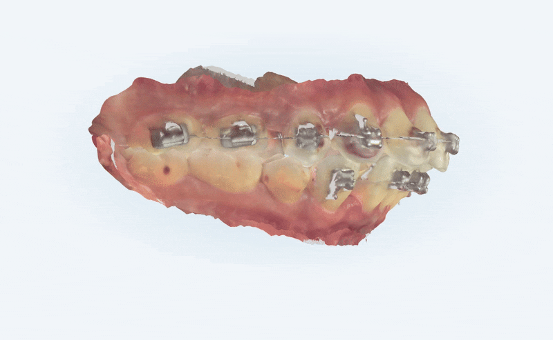 수술이 필요없는 잠실돌출입교정 잠실교정치과 입술이 잘 안다물어져 고민이라면? (돌출입전후 잠실새내교정치과 잠실발치교정 발치교정전후사진) 관련 이미지 3