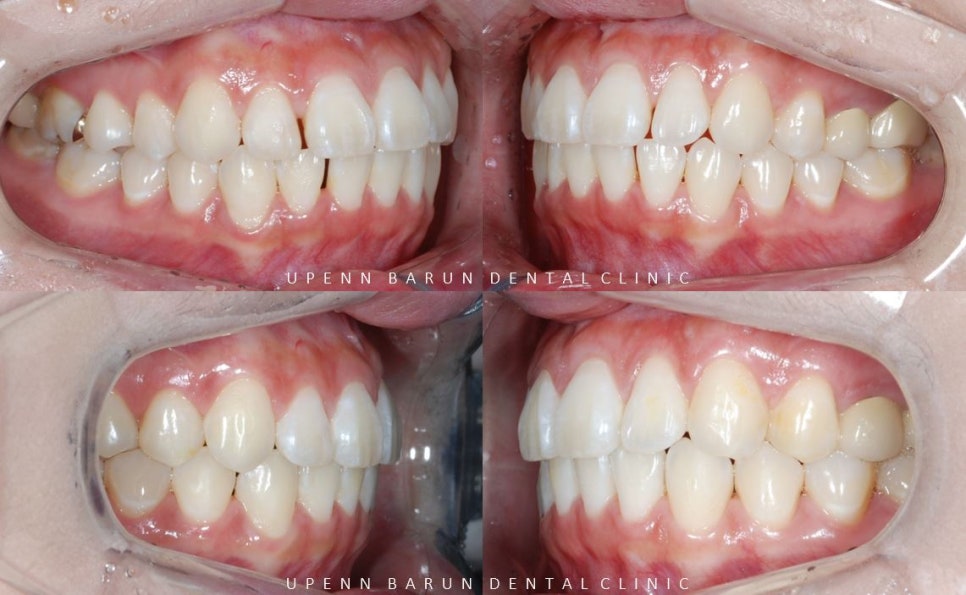 20대 여성 앞니 사이 틈 2개월만에 해결 (인비절라인익스프레스 INVISALIGN EXPRESS 인비절라인후기 잠실인비절라인  잠실투명교정치과) 관련 이미지 9