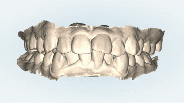잠실돌출입교정 잠실발치교정 후기가 궁금하다면? (교정후얼굴변화후기 잠실교정치과 돌출입교정후기 돌출입전후사진) 관련 이미지 3