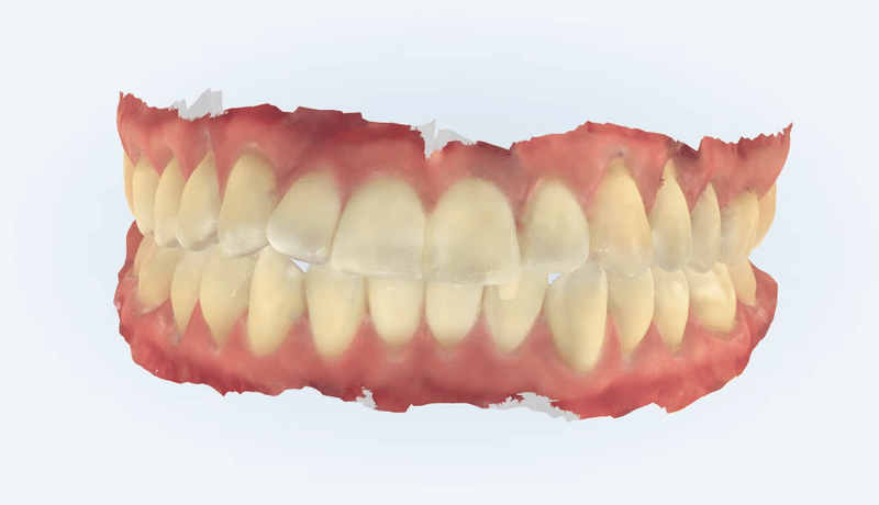 "치아가 앞으로 뻐드러졌어요!" 송파인비절라인다이아몬드등급치과에서!!(비발치인비절라인 뻐드렁니교정치과 돌출입교정치과) 관련 이미지 4