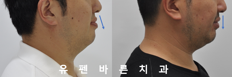 나스닥에 상장한 인비절라인, 잠실투명교정 잠실인비절라인 후기와 치아미백이 궁금하다면? 관련 이미지 18