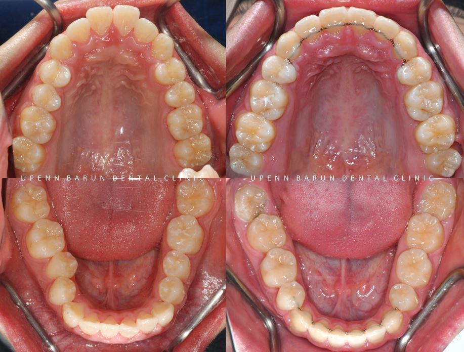 잠실청소년교정 청소년소년돌출입교정 잠실발치교정은 유펜바른치과에서! (잠실나루역교정치과 삼전역교정치과 잠실새내교정치과 돌출입전후 발치교정전후사진) 관련 이미지 12