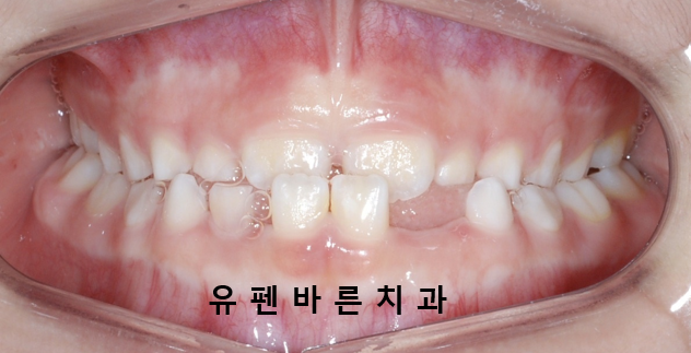 아이가 반대교합(주걱턱)인데 1차교정을 꼭해야 하나요? 관련 이미지 2