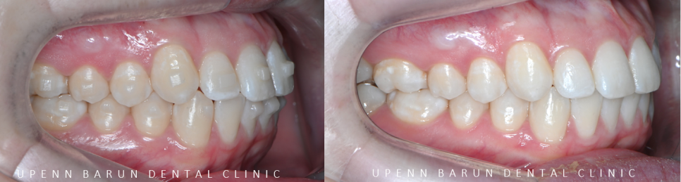 가지런했던 앞니가 삐뚤빼뚤해졌어요! 잠실다이아몬드등급 잠실인비절라인 인비절라인익스프레스 앞니 삐뚤어짐 해결(앞니급속교정 앞니투명교정 인비절라인급속교정 인비절라인전후사진) 관련 이미지 11
