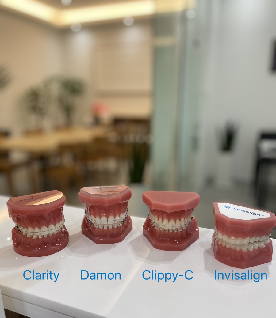 수술이 필요없는 잠실돌출입교정 잠실교정치과 입술이 잘 안다물어져 고민이라면? (돌출입전후 잠실새내교정치과 잠실발치교정 발치교정전후사진) 관련 이미지 2