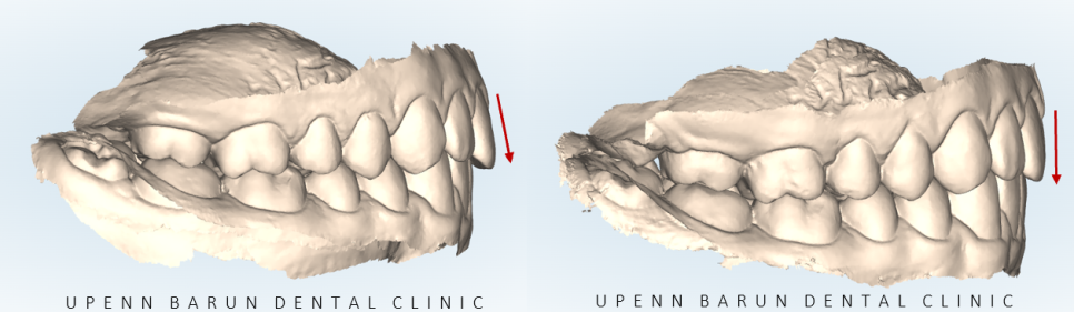 인비절라인다이아몬드등급치과에서 7주만에 앞니벌어짐 고민 해결한 후기(인비절라인앞니교정 인비절라인익스프레스 잠실인비절라인 인비절라인앞니교정후기) 관련 이미지 6