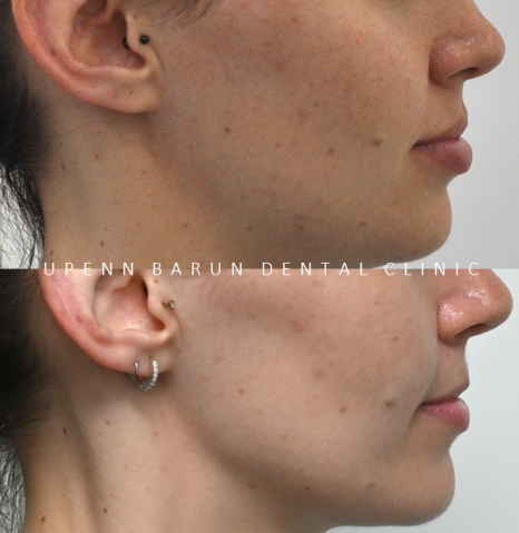 "치아가 앞으로 뻐드러졌어요!" 송파인비절라인다이아몬드등급치과에서!!(비발치인비절라인 뻐드렁니교정치과 돌출입교정치과) 관련 이미지 6