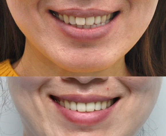 인비절라인 공식 스피커가 상주하고 치료하는 송파교정잘하는치과 유펜바른치과 (잠실성인교정 잠실재교정 잠실인비절라인 성인인비절라인교정 잠실나루역교정치과 문정동교정치과 삼전역교정치과) 관련 이미지 19