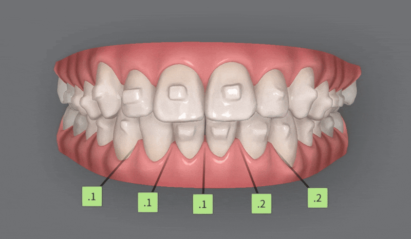 가지런했던 앞니가 삐뚤빼뚤해졌어요! 잠실다이아몬드등급 잠실인비절라인 인비절라인익스프레스 앞니 삐뚤어짐 해결(앞니급속교정 앞니투명교정 인비절라인급속교정 인비절라인전후사진) 관련 이미지 9