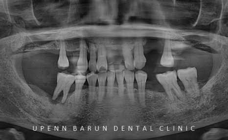 잠실새내역임플란트 잠실새내역치과 유펜바른치과에서 전체임플란트치료 ( 잠실임플란트후기 임플란트기간  전체임플란트) 관련 이미지 6
