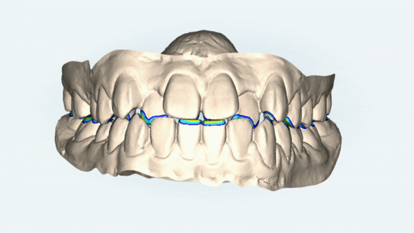 비발치교정 성장기교정 청소년치아교정은 잠실교정치과 유펜바른치과에서 관련 이미지 3