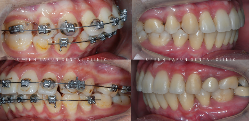수술이 필요없는 잠실돌출입교정 잠실교정치과 입술이 잘 안다물어져 고민이라면? (돌출입전후 잠실새내교정치과 잠실발치교정 발치교정전후사진) 관련 이미지 7