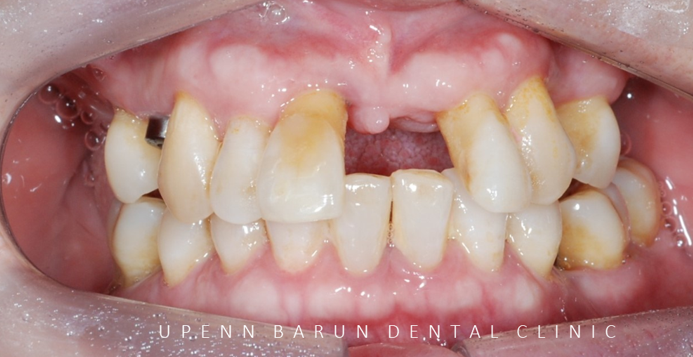 잠실새내역임플란트 잠실새내역치과 유펜바른치과에서 전체임플란트치료 ( 잠실임플란트후기 임플란트기간  전체임플란트) 관련 이미지 4