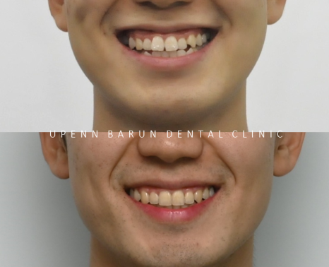 주걱턱 반대교합도 잠실인비절라인 잠실교정치과 유펜바른치과에서!(비발치주걱턱교정 잠실성인교정 반대교합인비절라인 잠실교정치과 주걱턱교정후기) 관련 이미지 4