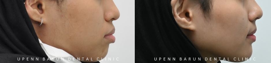 잠실돌출입교정 잠실발치교정 후기가 궁금하다면? (교정후얼굴변화후기 잠실교정치과 돌출입교정후기 돌출입전후사진) 관련 이미지 8