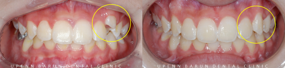 잠실소아인비절라인 잠실어린이인비절라인 송파인비절라인 잠실인비절라인후기 (잠실새내교정치과 엘스상가교정치과 파인애플상가교정치과 잠실새내역인비절라인 청소년교정후기 잠실인비절라인퍼스트) 관련 이미지 10
