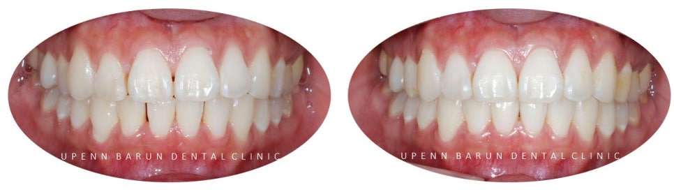 20대 여성 앞니 사이 틈 2개월만에 해결 (인비절라인익스프레스 INVISALIGN EXPRESS 인비절라인후기 잠실인비절라인  잠실투명교정치과) 관련 이미지 10