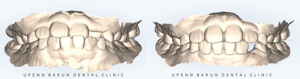 8세 어린이반대교합 인비절라인퍼스트로 수월하게 해결 후기! 잠실인비절라인퍼스트 잠실인비절라인소아교정 (잠실교정치과 잠실인비절라인 인비절라인등급 인비절라인후기 잠실소아교정) 관련 이미지 4