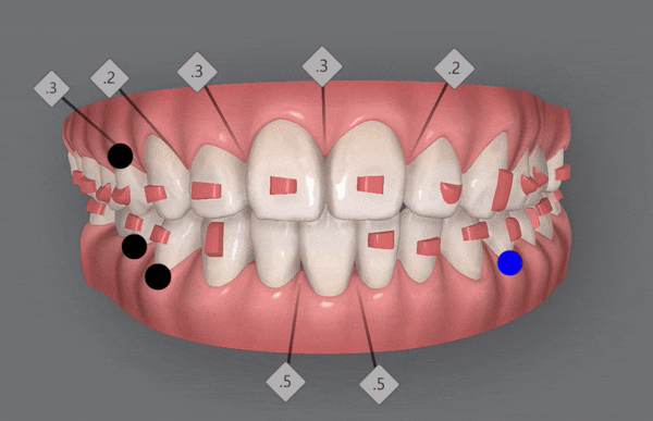 인비절라인 공식 스피커가 상주하고 치료하는 송파교정잘하는치과 유펜바른치과 (잠실성인교정 잠실재교정 잠실인비절라인 성인인비절라인교정 잠실나루역교정치과 문정동교정치과 삼전역교정치과) 관련 이미지 6