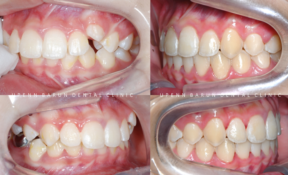 잠실소아인비절라인 잠실어린이인비절라인 송파인비절라인 잠실인비절라인후기 (잠실새내교정치과 엘스상가교정치과 파인애플상가교정치과 잠실새내역인비절라인 청소년교정후기 잠실인비절라인퍼스트) 관련 이미지 19
