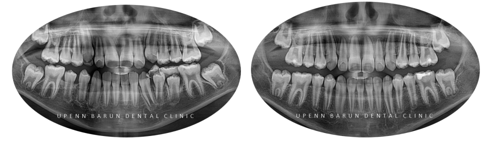 송파인비절라인다이아몬드등급치과 에서 인비절라인으로 1차 2차 교정을 한번에! (송파인비절라인퍼스트 잠실어린이인비절라인 인비절라인소아교정 잠실소아교정 어린이반대교합) 관련 이미지 19