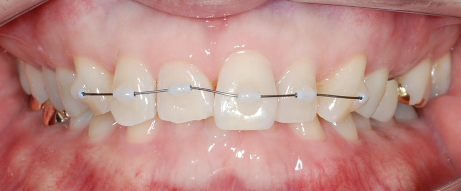 미니튜브를 이용한 MTA 교정 (앞니 부분 교정) 관련 이미지 12