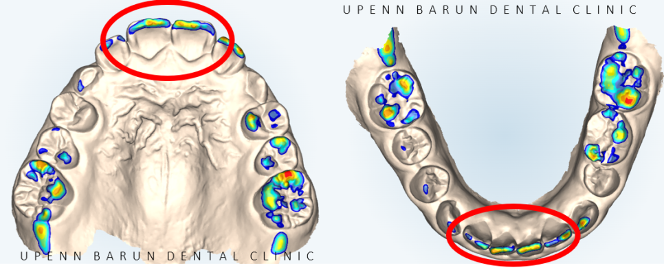 송파인비절라인다이아몬드등급치과 에서 인비절라인으로 1차 2차 교정을 한번에! (송파인비절라인퍼스트 잠실어린이인비절라인 인비절라인소아교정 잠실소아교정 어린이반대교합) 관련 이미지 6