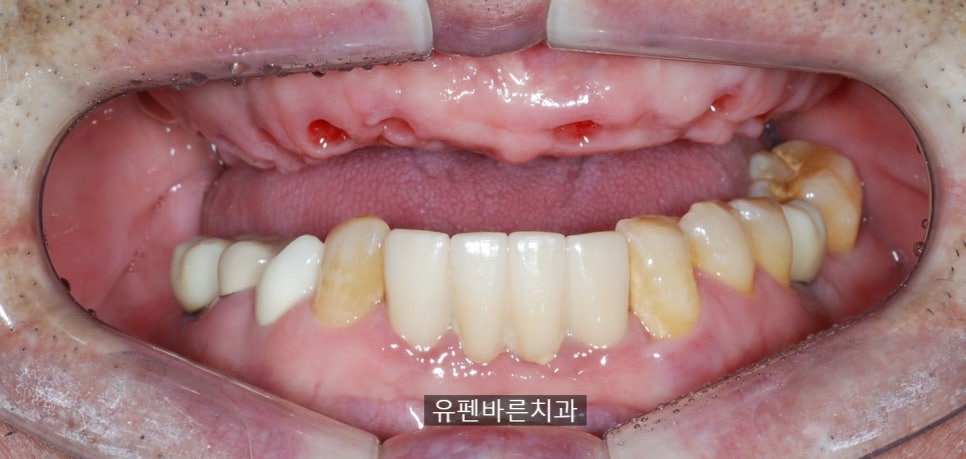 해보니까 임플란트가 편해요!!! 관련 이미지 5