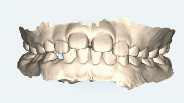 유독 튀어나와 다치기 쉬운 앞니! INVISALIGN FIRST로 8개월만에 끝낸 후기 (송파인비절라인소아교정 인비절라인1차교정 송파인비절라인퍼스트  송파인비절라인어린이교정) 관련 이미지 4