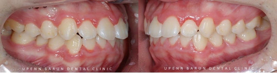 잠실청소년교정 청소년소년돌출입교정 잠실발치교정은 유펜바른치과에서! (잠실나루역교정치과 삼전역교정치과 잠실새내교정치과 돌출입전후 발치교정전후사진) 관련 이미지 5