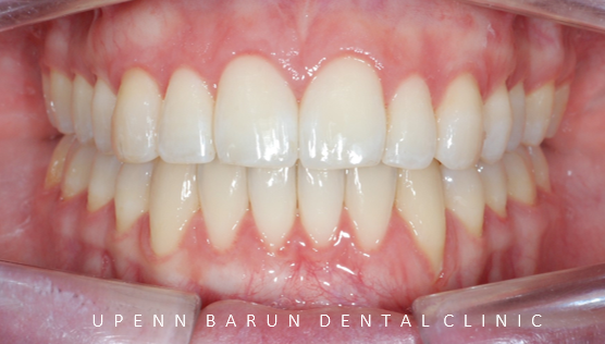 개방교합은 교정용 미니스크류 쓰지말고 인비절라인만으로 쉽게 해결하세요! (잠실인비절라인  잠실새내인비절라인  개방교합교정  잠실새내교정치과) 관련 이미지 6