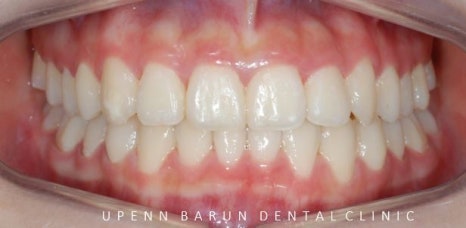 '웃을때 입을 자꾸 가려요'  활짝 웃은 중학생 비발치 인비절라인후기 (잠실새내인비절라인 청소년인비절라인 잠실교정치과) 관련 이미지 12